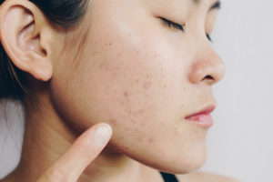 9 methods for relieving dim spots from skin inflammation as fast as could be expected