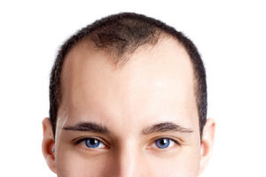 abnormal hair loss Caused by what?