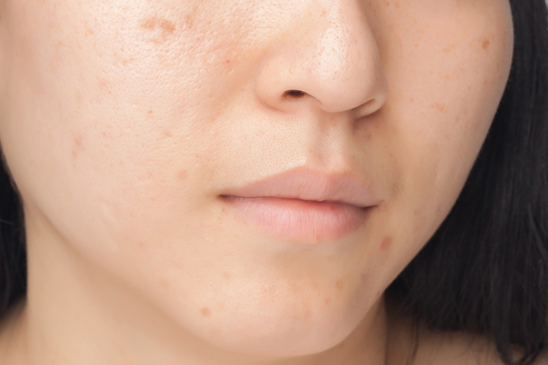 How to remove scars on your face yourself