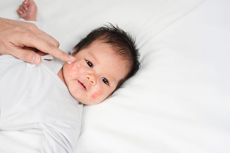 8 rash creams on baby’s face to reduce itchy rashes