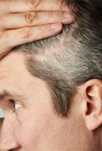 What causes premature gray hair?