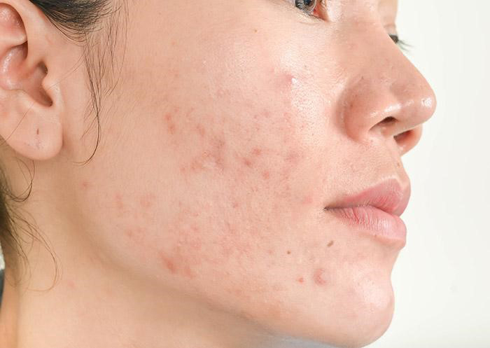 What is steroid acne?